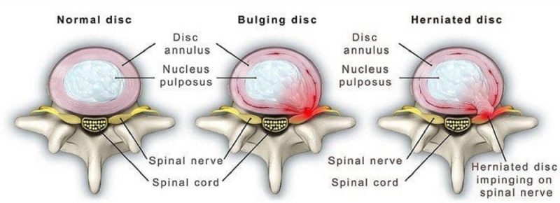 bulging-disc-non-surgical-treatments-novus-spine-pain-center