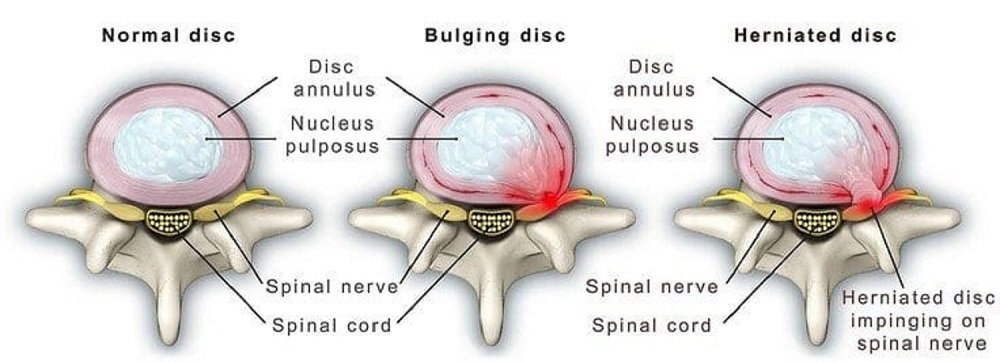 ipicture of bulging disc on spine