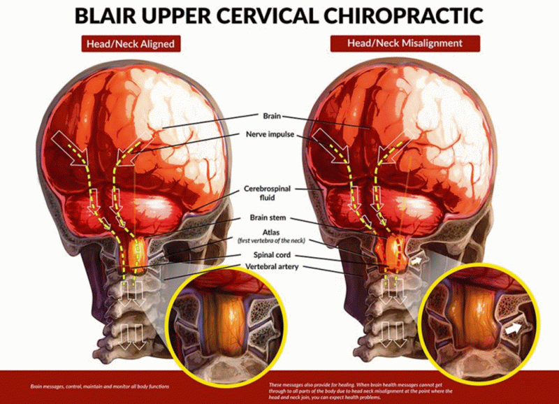 Connection Between a Short Leg and Upper Cervical Chiropractic